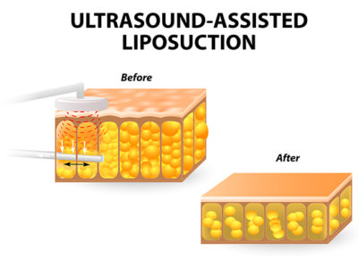 Vaser-Lipo-Areas