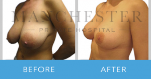 breast-reduction