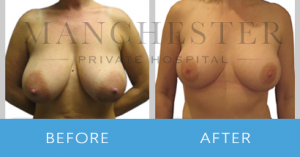 breast-reduction