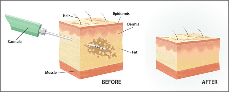 vaser-liposuction-procedure