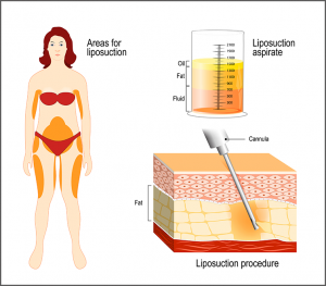 vaser-liposuction-procedure