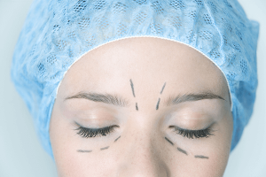 blepharoplasty