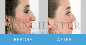 rhinoplasty