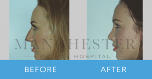 rhinoplasty