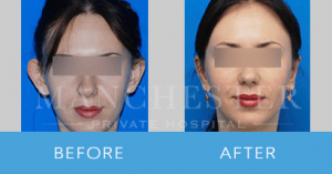 otoplasty-female before-after