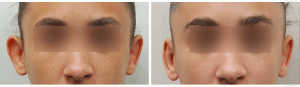 otoplasty-female before-after