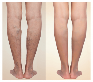 varicose-veins-removal